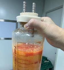 温州水动力吸脂手术要做多久？